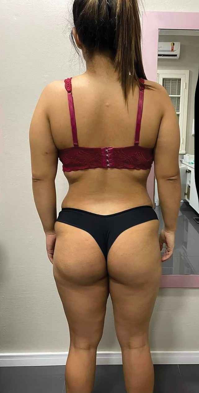 Depois do tratamento